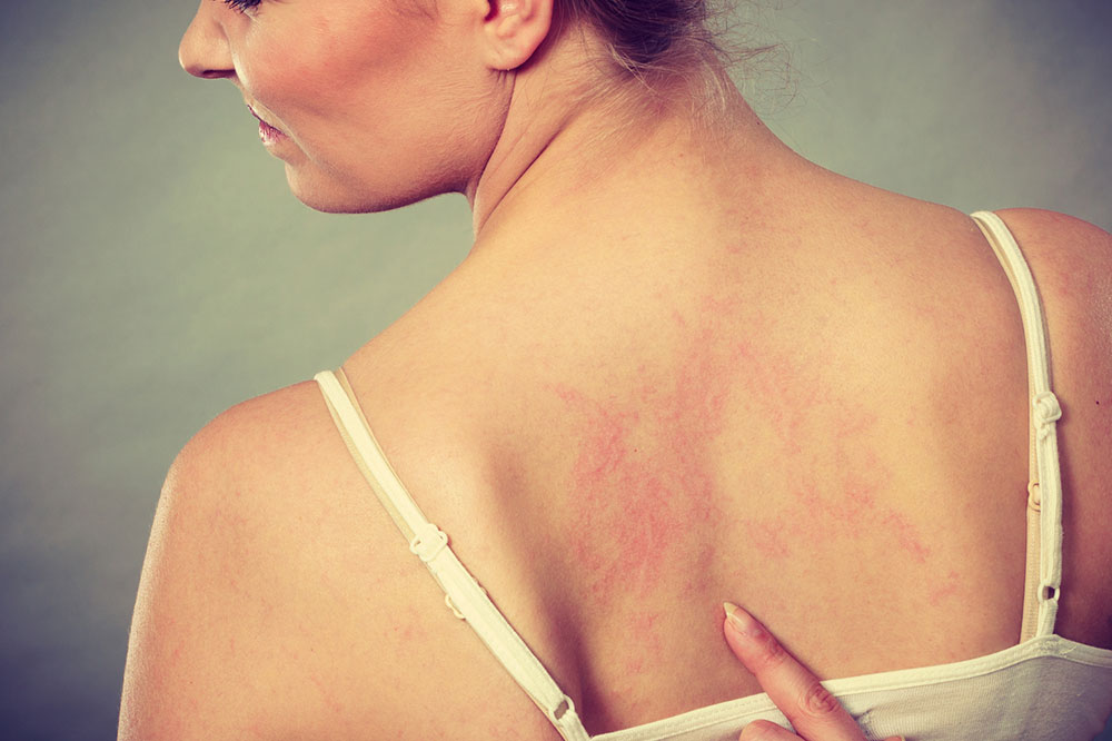 5 main types of psoriasis